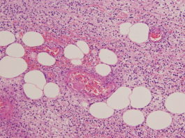 Emofilo influenza B (Hib): Istituto Superiore di Sanità si contraddice