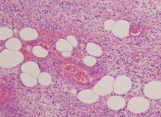 Emofilo influenza B (Hib): Istituto Superiore di Sanità si contraddice