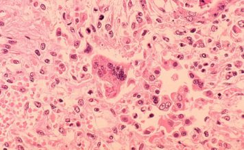 Morbillo – Cos’é il morbillo?