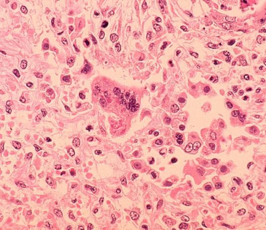 Morbillo – Cos’é il morbillo?