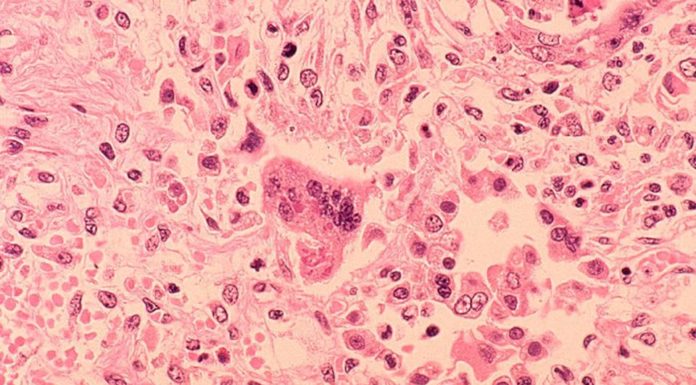 Morbillo – Cos’é il morbillo?