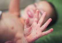 PIANO ERADICAZIONE MORBILLO – Lettera alle istituzioni