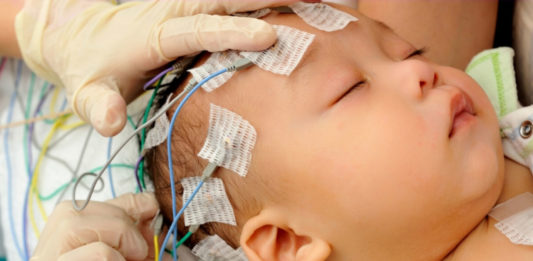 Convulsioni da vaccino MPR ed epilessia