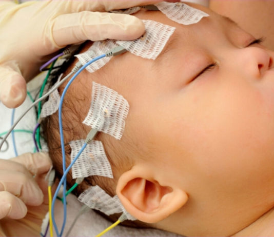 Convulsioni da vaccino MPR ed epilessia