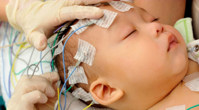 Convulsioni da vaccino MPR ed epilessia